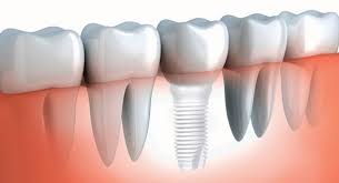 Implantes dentales de Zirconia
