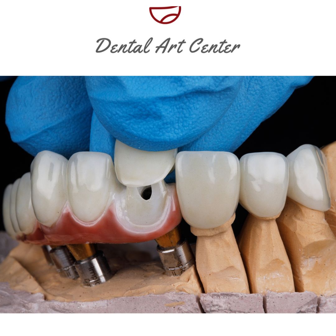 prótesis híbirdas Implantes Dentales